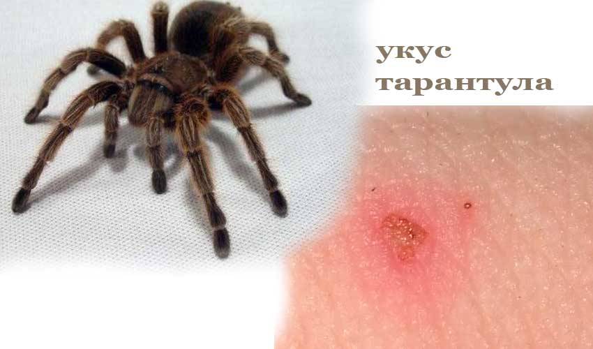 Укус тарантула: симптомы, первая помощь, лечение, последствия | мрикрнц.рф
