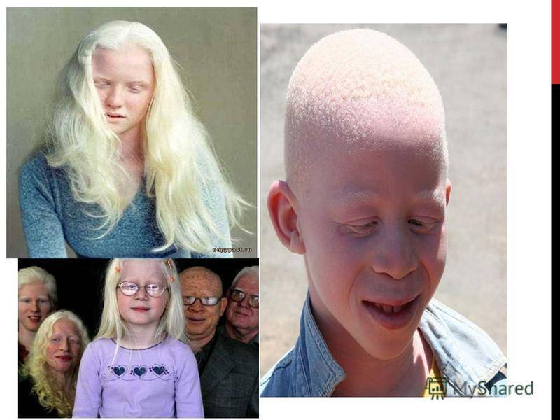 Люди альбиносы: цвет глаз, интересные фото и факты