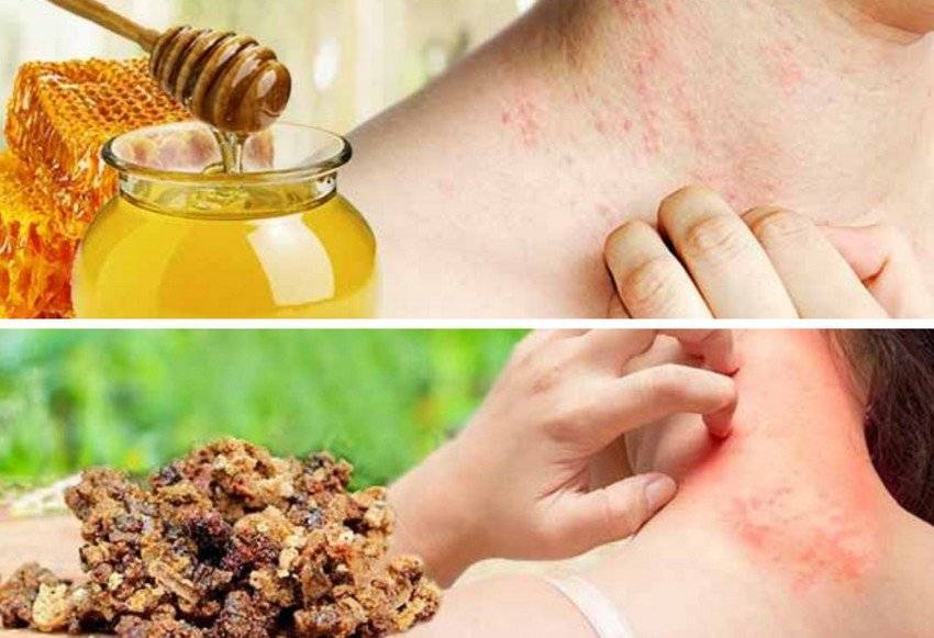 Сезонная аллергия: причины, лечение, профилактика