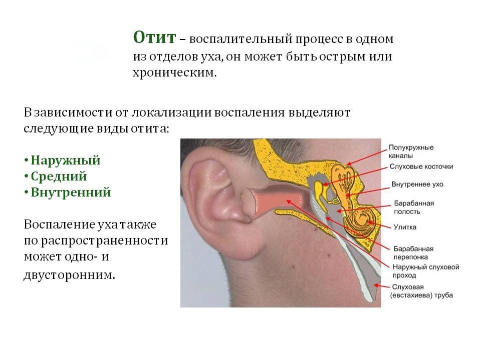 Острый гнойный отит среднего уха — симптомы и лечение воспалений у взрослых на любых стадиях